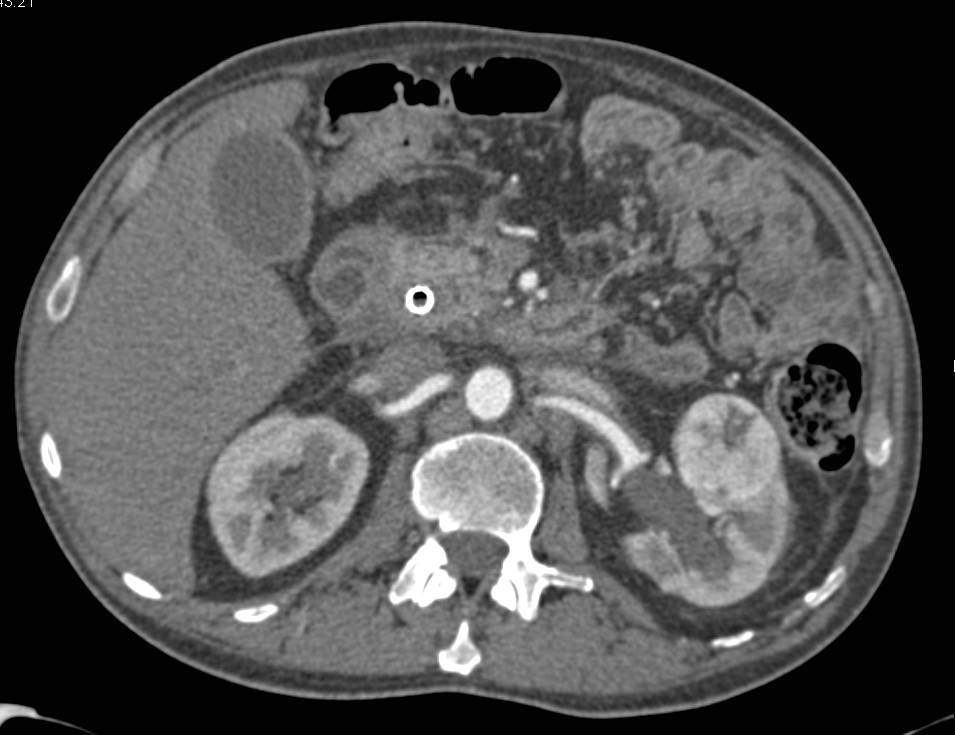 Incidental Renal Cell Carcinoma in a Patient with Pancreatic Cancer - CTisus CT Scan