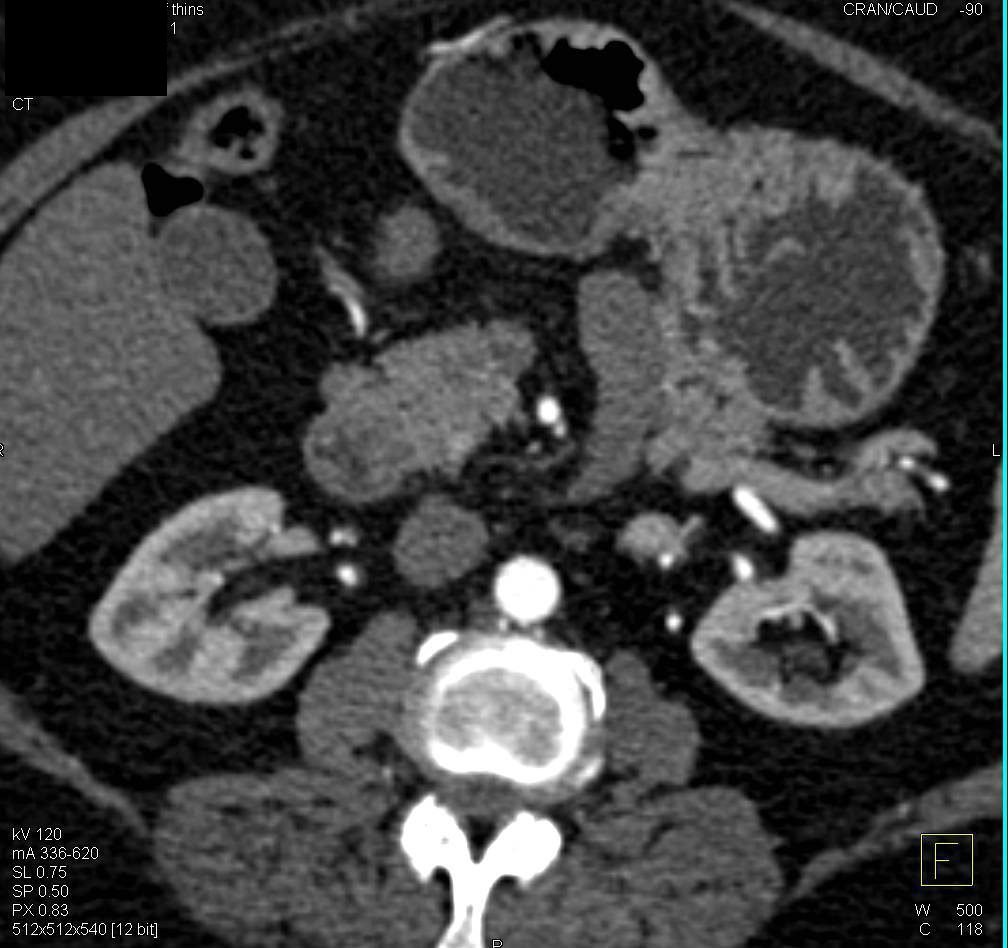 5mm Neuroendocrine Tumor in the Head of the Pancreas - CTisus CT Scan