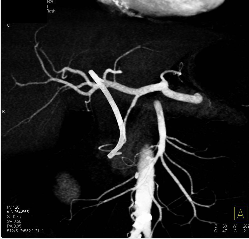 Pancreatic Adenocarcinoma Encases the Gastroduodenal Artery (GDA) - CTisus CT Scan