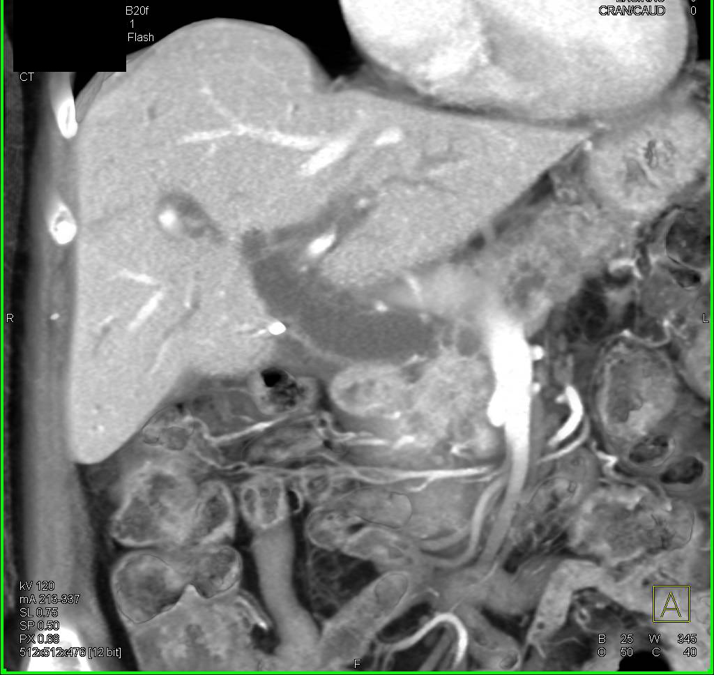 Ampullary Cancer with Dilated Common Bile Duct (CBD) - CTisus CT Scan