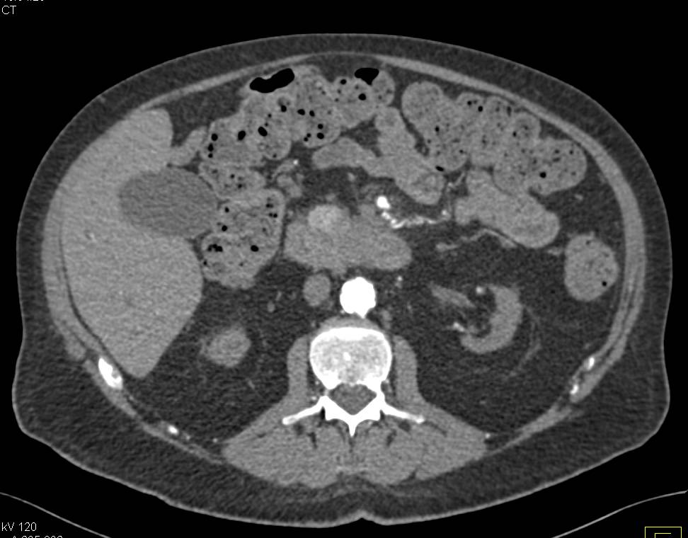 Pancreatic Cancer Encases the SMA - CTisus CT Scan