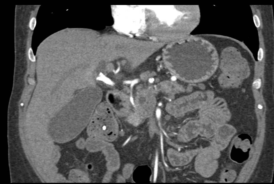 Pancreatic Adenocarcinoma Arises in an Intraductal Papillary Mucinous Neoplasm (IPMN) - CTisus CT Scan