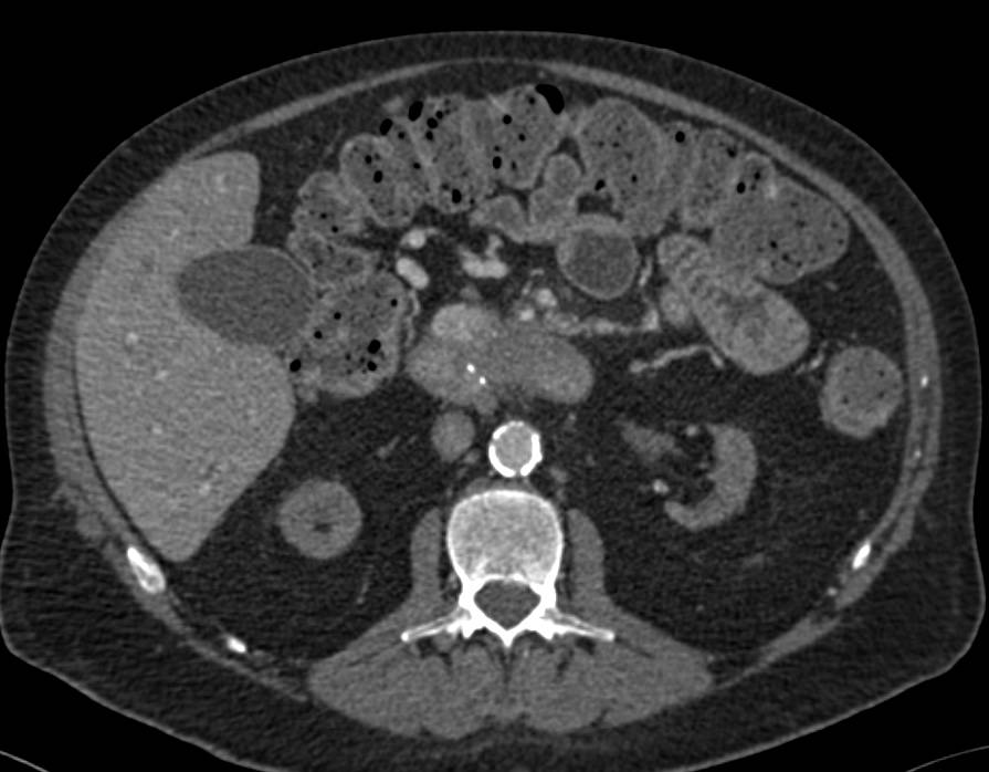 Carcinoma of the Head of the Pancreas - CTisus CT Scan