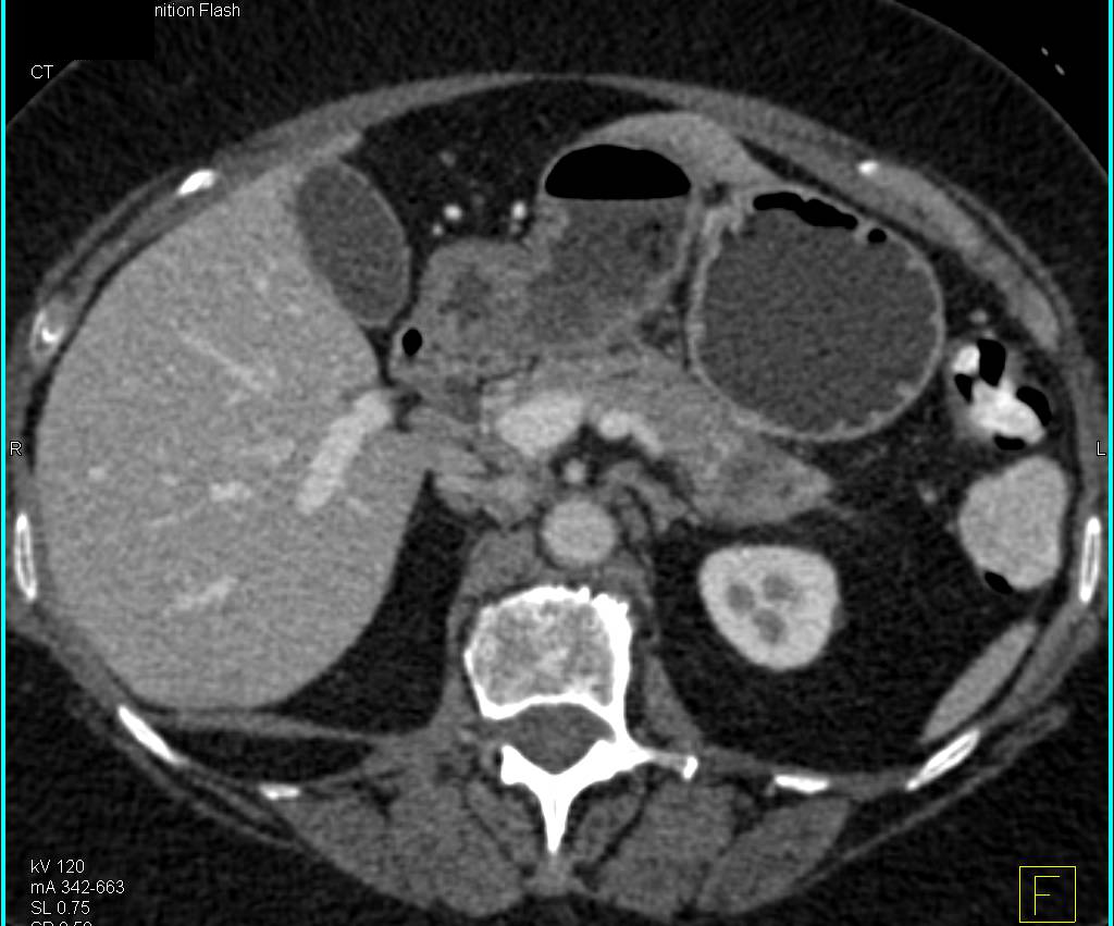Pancreatic Cancer with Carcinomatosis - CTisus CT Scan