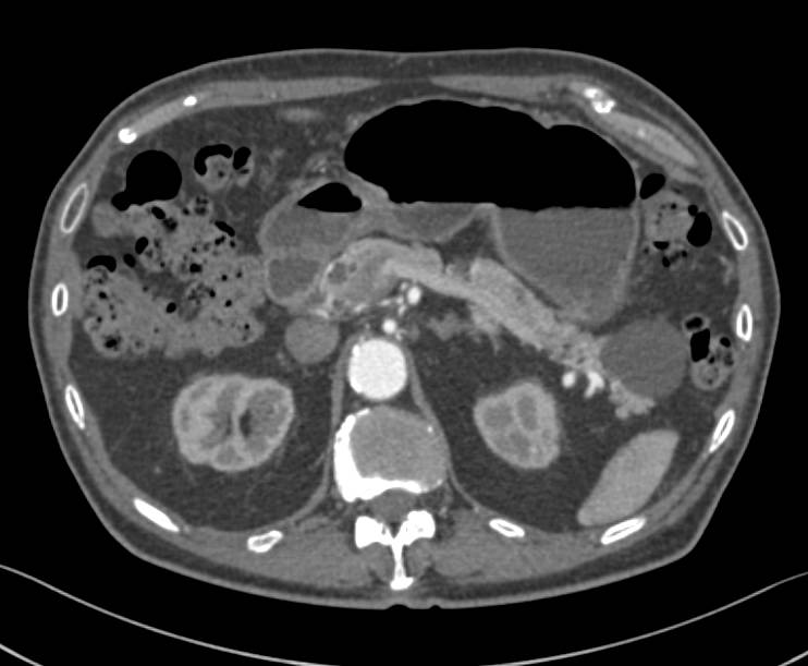 Serous Cystadenoma - CTisus CT Scan