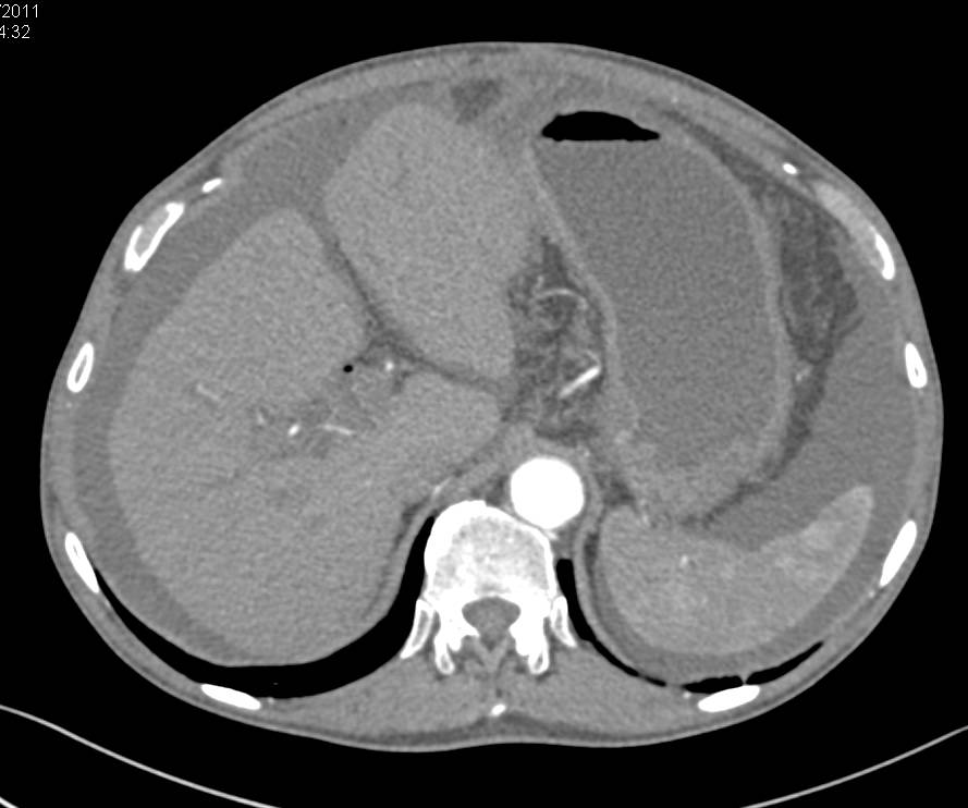 Pancreatic Adenocarcinoma with Carcinomatosis - CTisus CT Scan