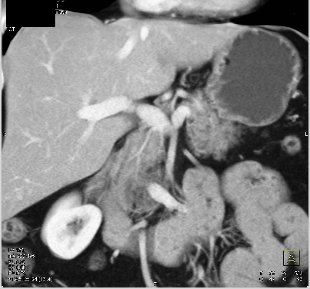 Focal Fatty Infiltration of the Pancreas Simulates a Mass - CTisus CT Scan