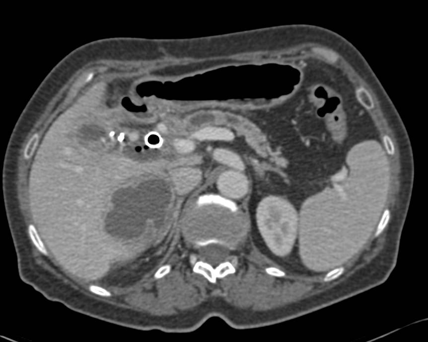 Pancreatic Cancer with Necrotic Liver Metastases - CTisus CT Scan