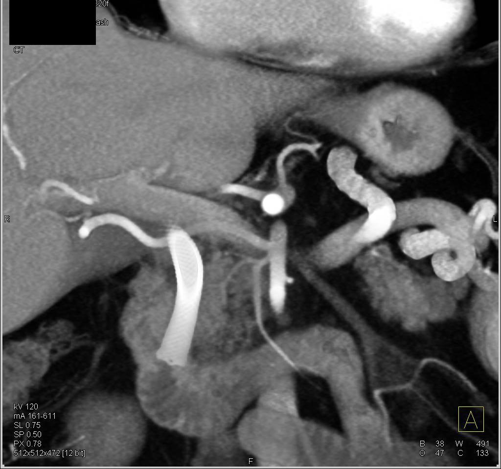 Accessory Right Hepatic Artery Arises off Superior Mesenteric Artery (SMA) in Patient Planning for Whipple Procedure - CTisus CT Scan