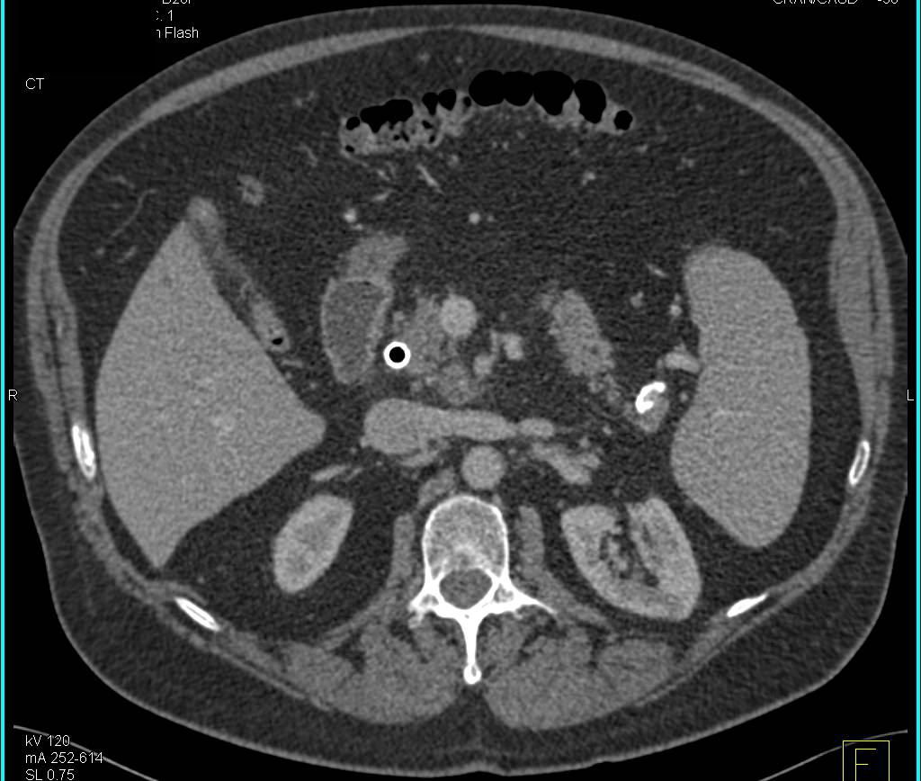 Pancreatic Cancer - CTisus CT Scan