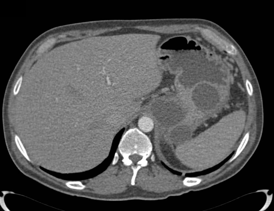 Pancreatic Pseudocysts - CTisus CT Scan