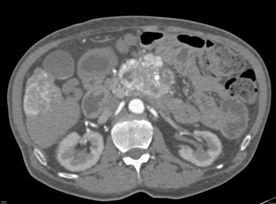 Neuroendocrine Tumor of the Pancreas with Liver Metastases and Incredible Collaterals - CTisus CT Scan