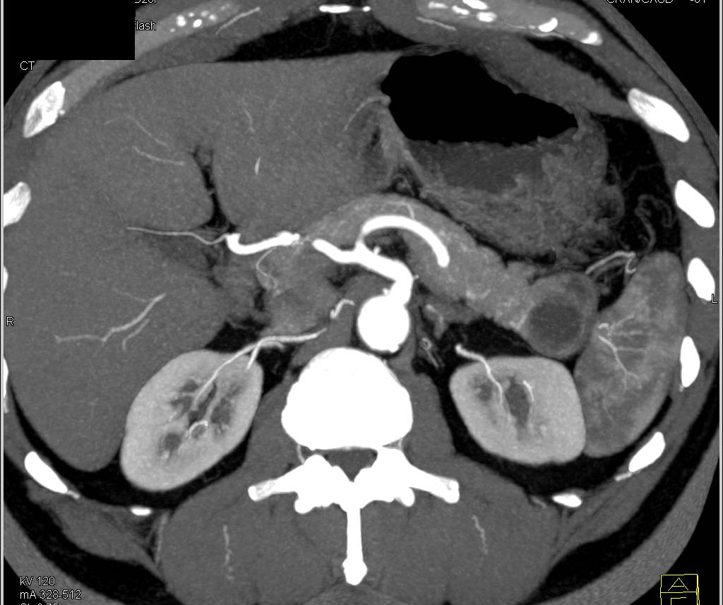 Cystic Neuroendocrine Tumor in Tail of the Pancreas - CTisus CT Scan