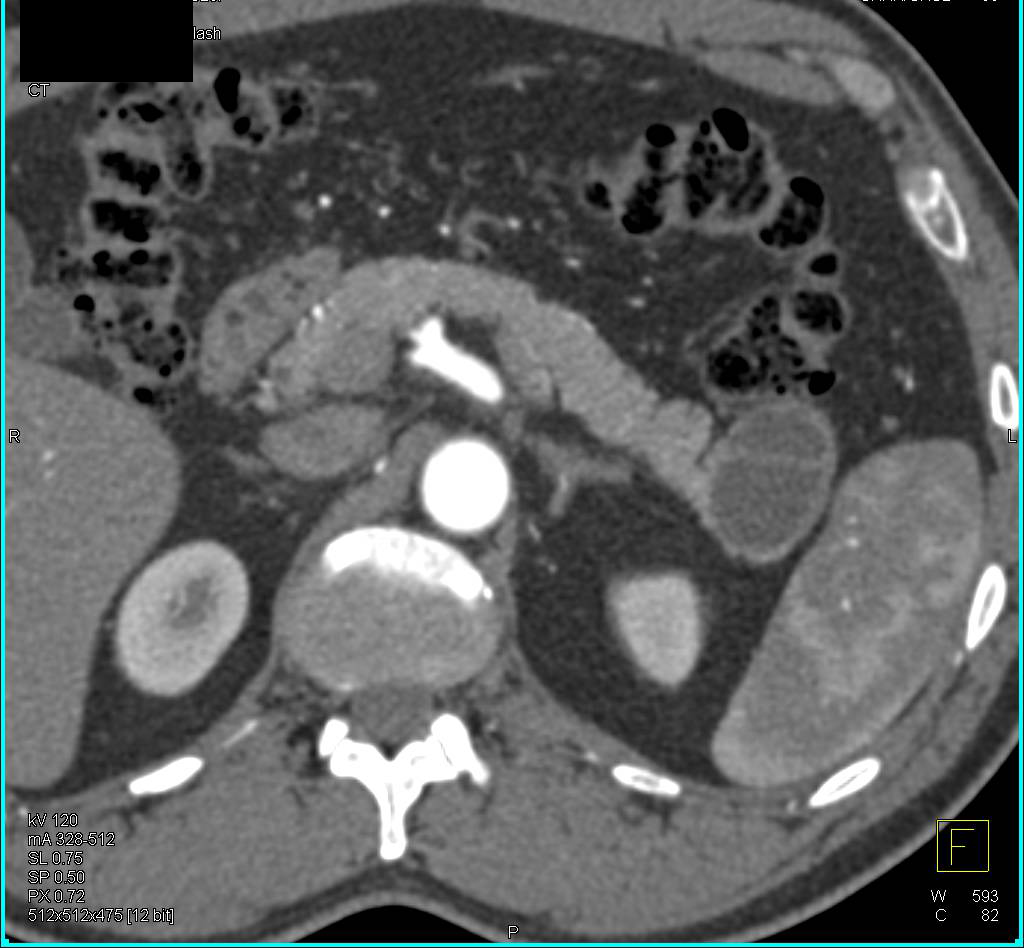 Cystic Neuroendocrine Tumor in Tail of the Pancreas - CTisus CT Scan