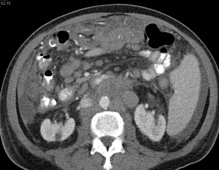 Pancreatic Cancer with Carcinomatosis - CTisus CT Scan