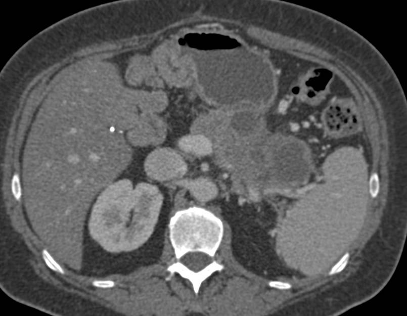 Pancreatitis with Pseudocyst near Tail of the Pancreas - CTisus CT Scan