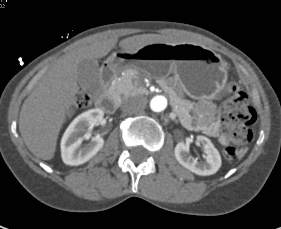 Serous Cystadenoma Tail of the Pancreas - CTisus CT Scan