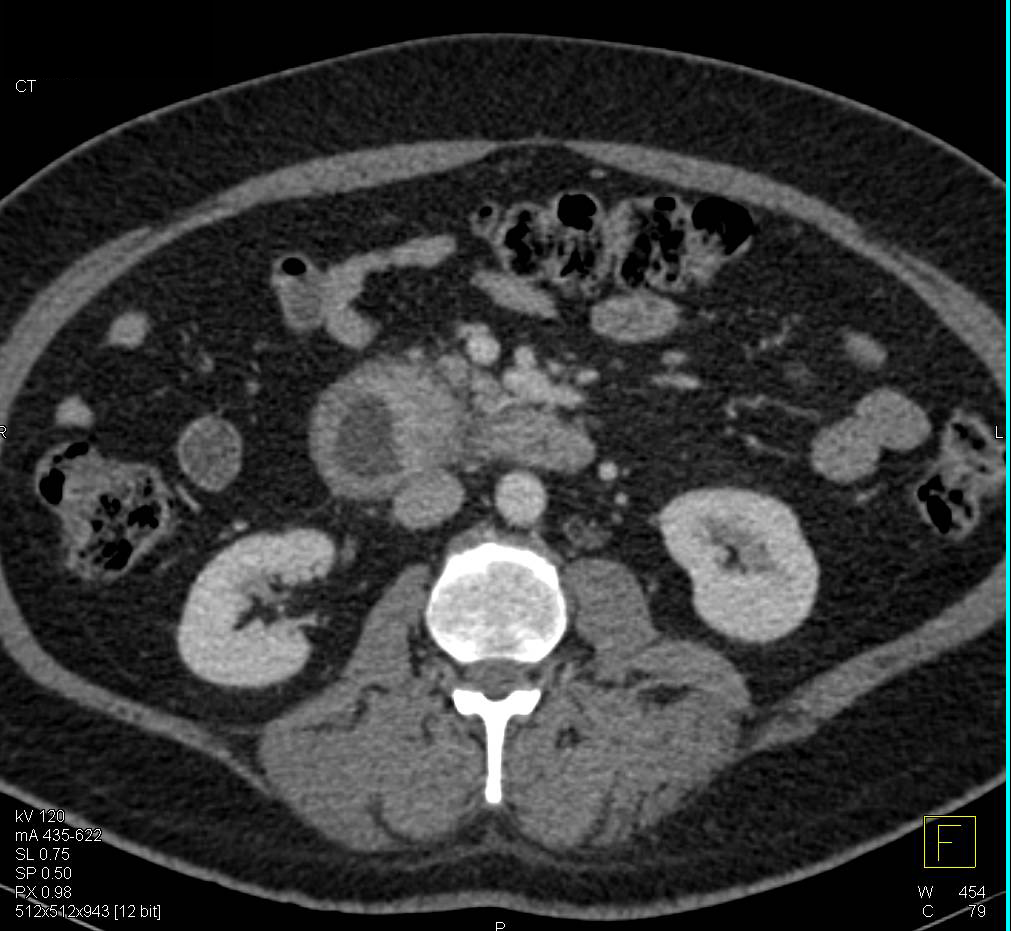 Duodenal Adenocarcinoma - CTisus CT Scan