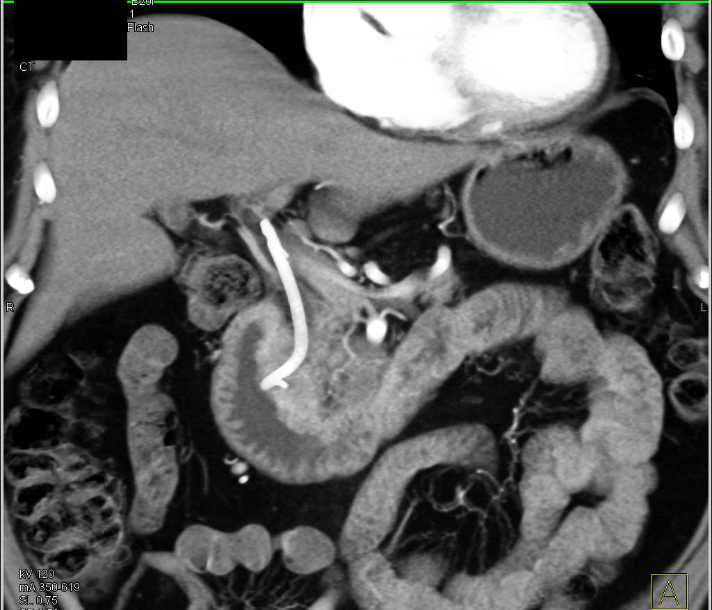 Ampullary Carcinoma Seen Well in 3D - CTisus CT Scan