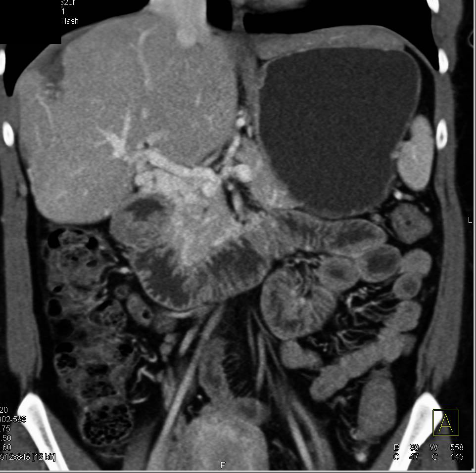 Cavernous Transformation of the Portal Vein and Pancreatic Cancer - CTisus CT Scan