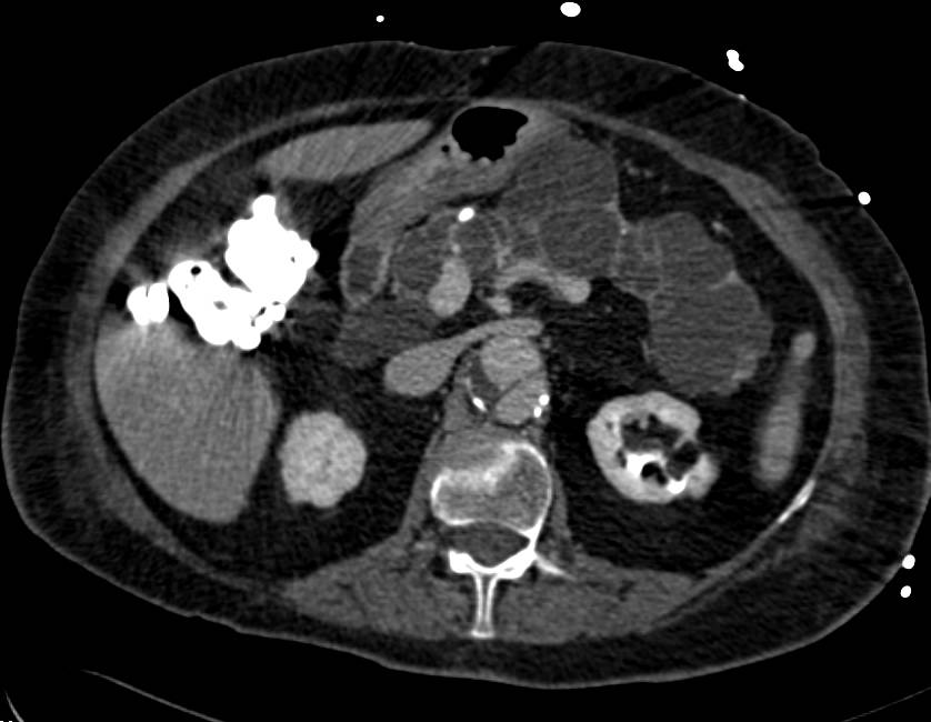 Multiple Intraductal Papillary Mucinous Neoplasms (IPMNs) in the Pancreas - CTisus CT Scan