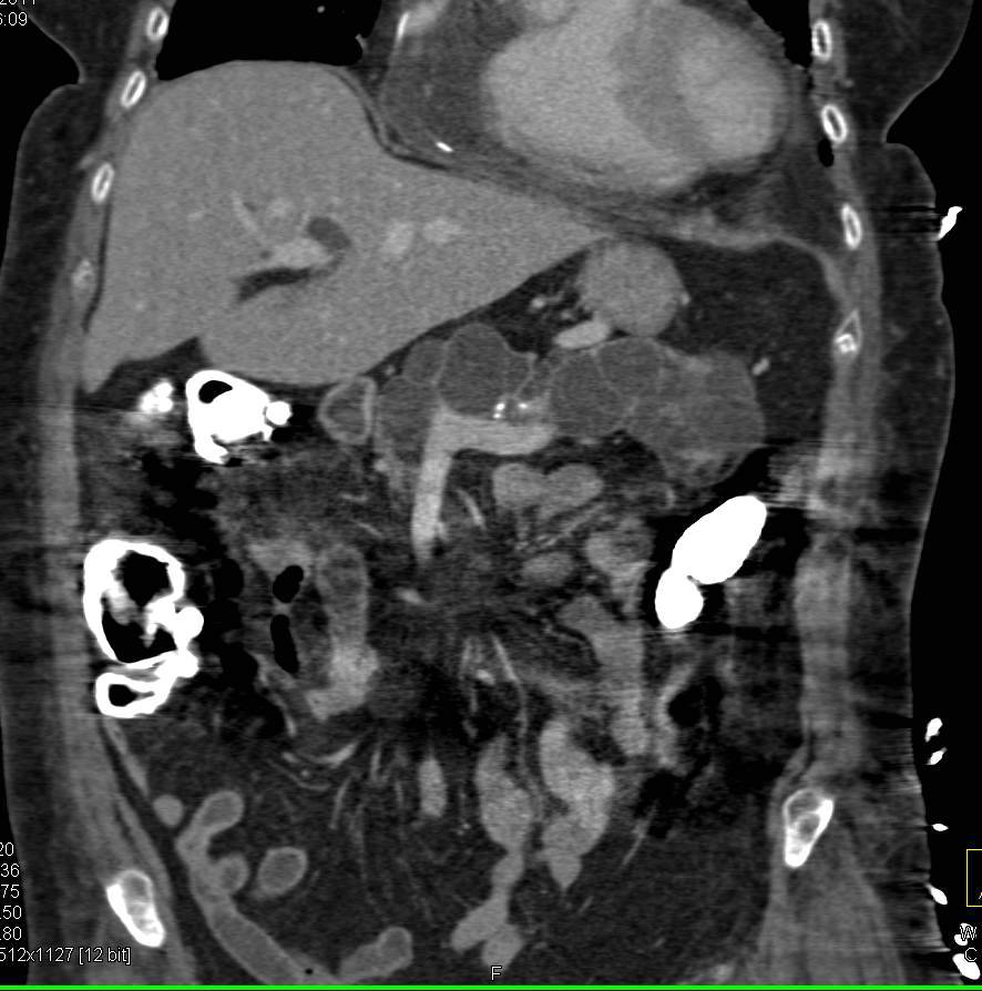 Multiple Intraductal Papillary Mucinous Neoplasms (IPMNs) with Moderate Grade Dysplasia - CTisus CT Scan