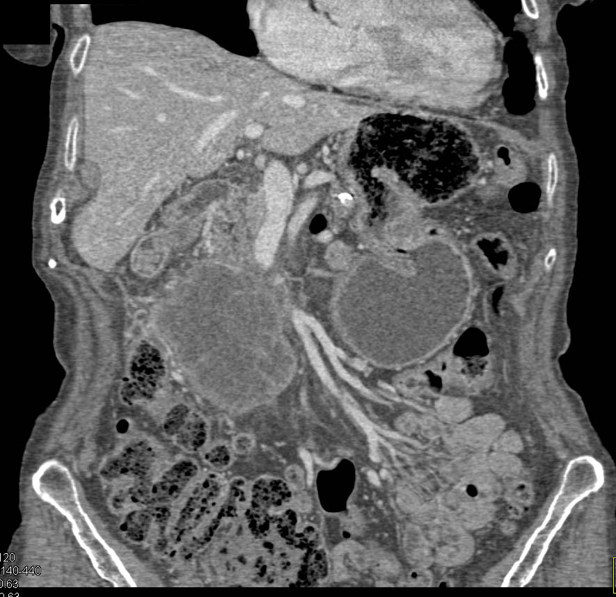 Cystadenocarcinoma of the Pancreatic Head - CTisus CT Scan