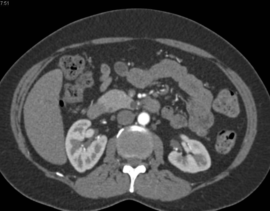 1 cm Intraductal Papillary Mucinous Neoplasm (IPMN) - CTisus CT Scan