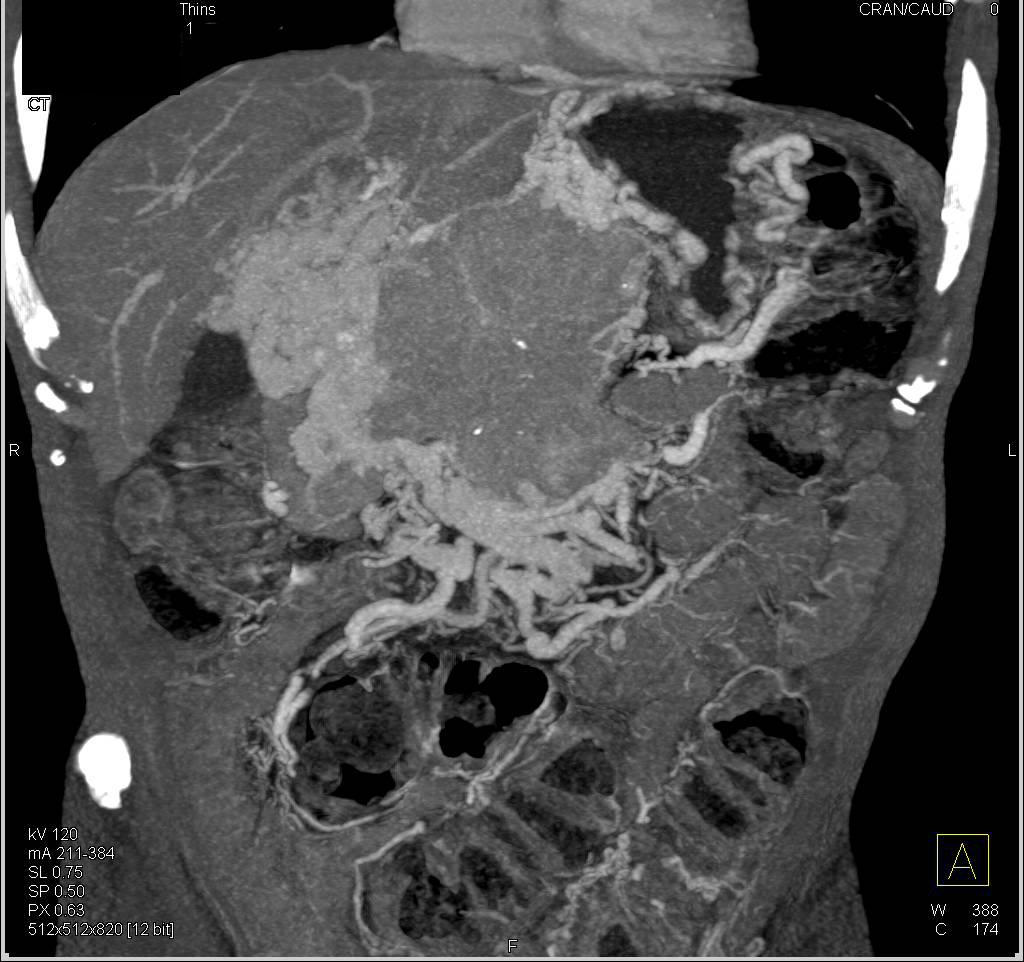 Neuroendocrine Tumor of the Pancreas Invades the Portal Vein and Superior Mesenteric Vein (SMV) - CTisus CT Scan