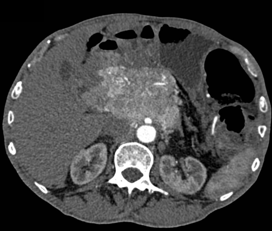 Neuroendocrine Tumor of the Head of the Pancreas - CTisus CT Scan