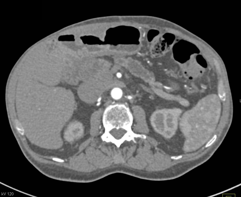 Dilated Pancreatic Duct in Patient s/p Whipple Procedure - Pancreas ...