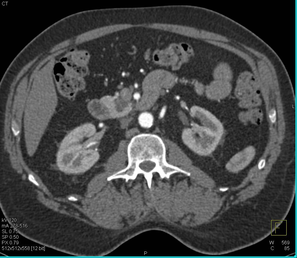 Intraductal Papillary Mucinous Neoplasm (IPMN) in Head of Pancreas - CTisus CT Scan