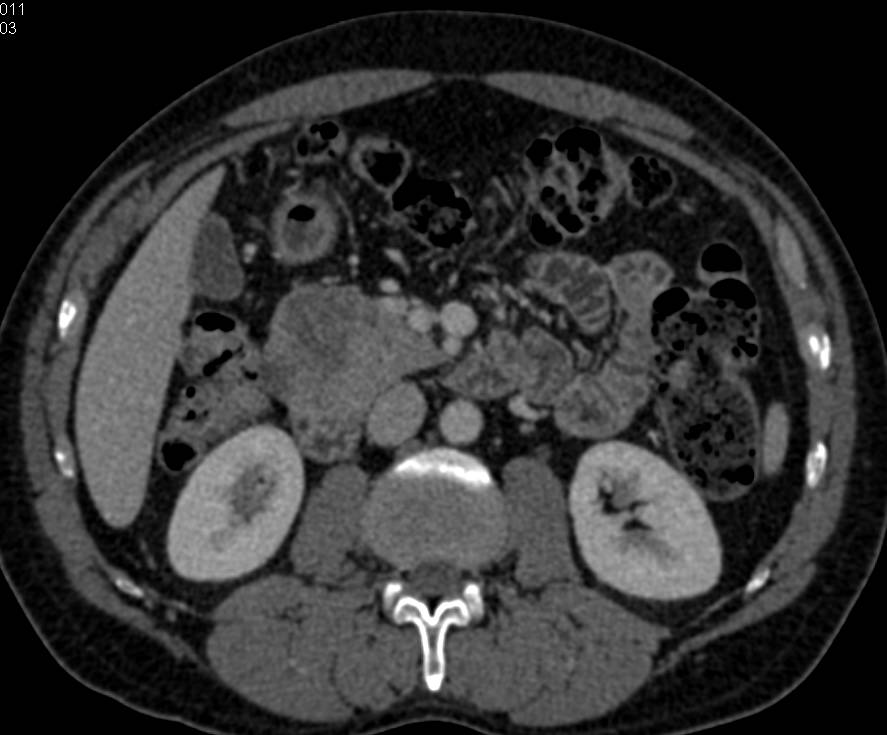 Subtle Adenocarcinoma of the Pancreas - CTisus CT Scan