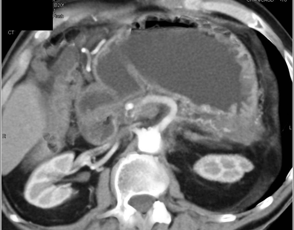 Carcinoma of the Tail of the Pancreas with Vessel Invasion - CTisus CT Scan