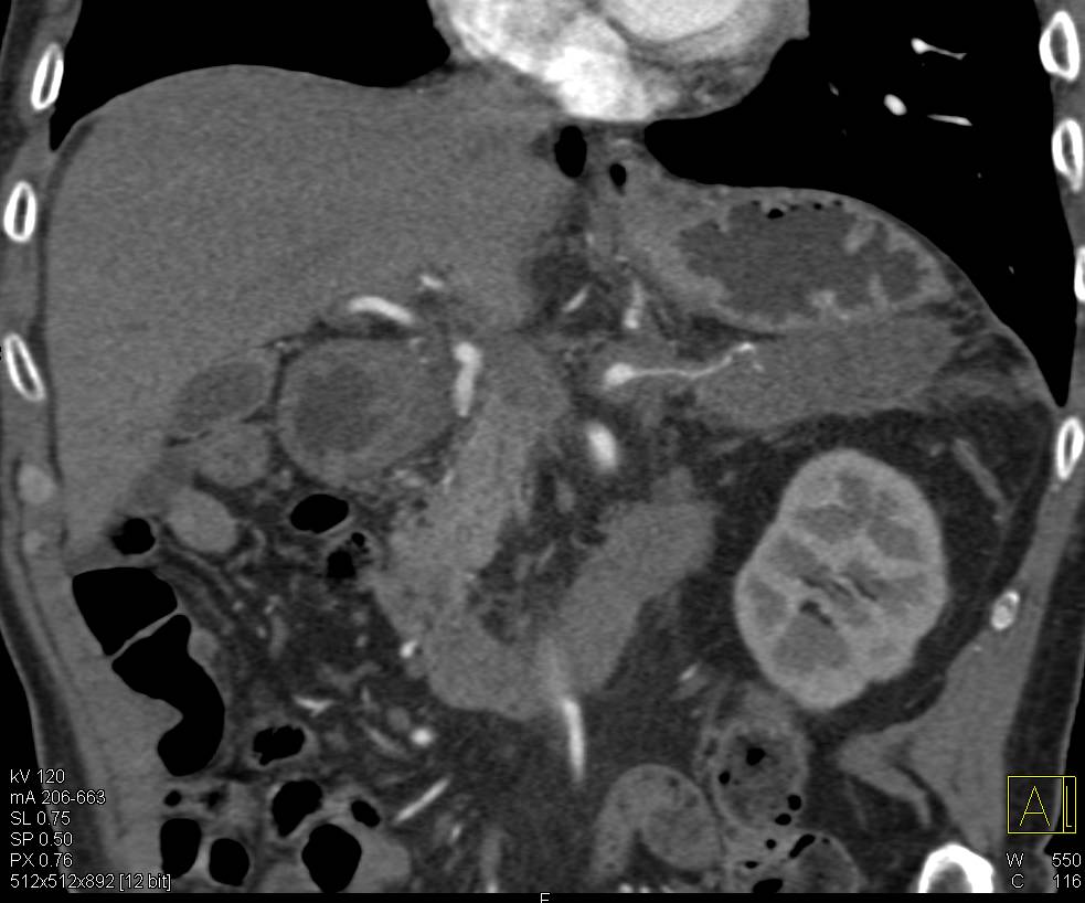 Celiac Artery Encased by Subtle Pancreatic Adenocarcinoma - CTisus CT Scan