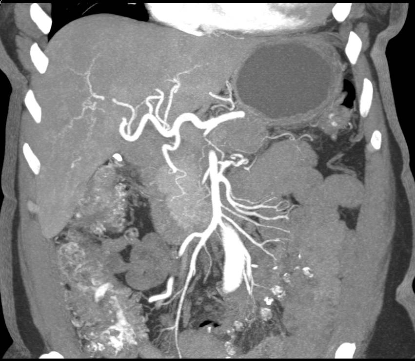 Pancreatic Adenocarcinoma Obstructs the Pancreatic Duct. Liver Metastases as well. - CTisus CT Scan