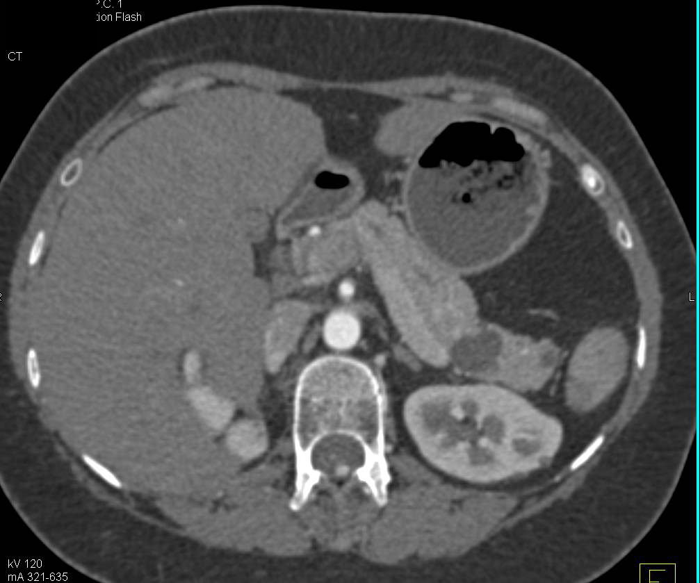 Multiple Intraductal Papillary Mucinous Neoplasms (IPMNs) with Largest in the Tail of the Pancreas - CTisus CT Scan