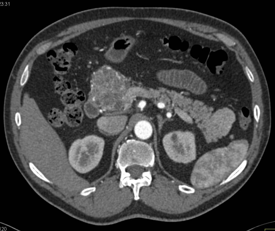 Vascular Serous Cystadenoma - CTisus CT Scan