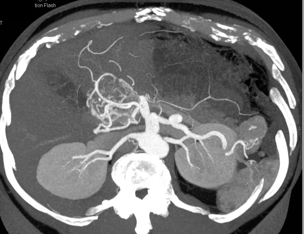 Serous Cystadenoma with Prominent Vasculature - CTisus CT Scan