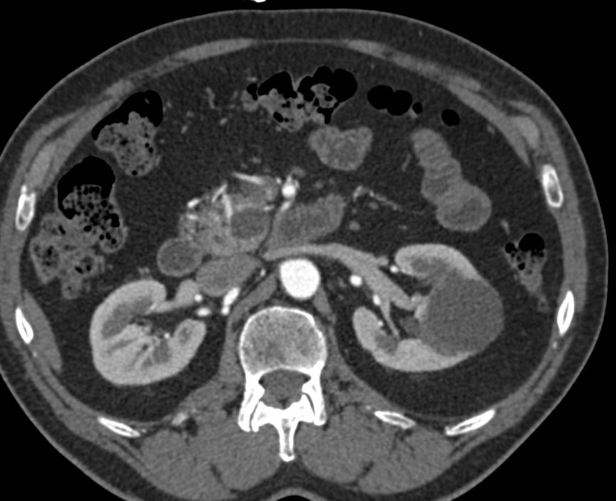 Serous Cystadenoma in Head of the Pancreas - CTisus CT Scan