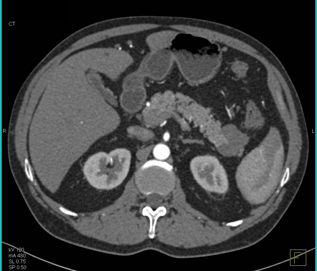 Lymphoepithelial Cyst Near Tail of the Pancreas - CTisus CT Scan