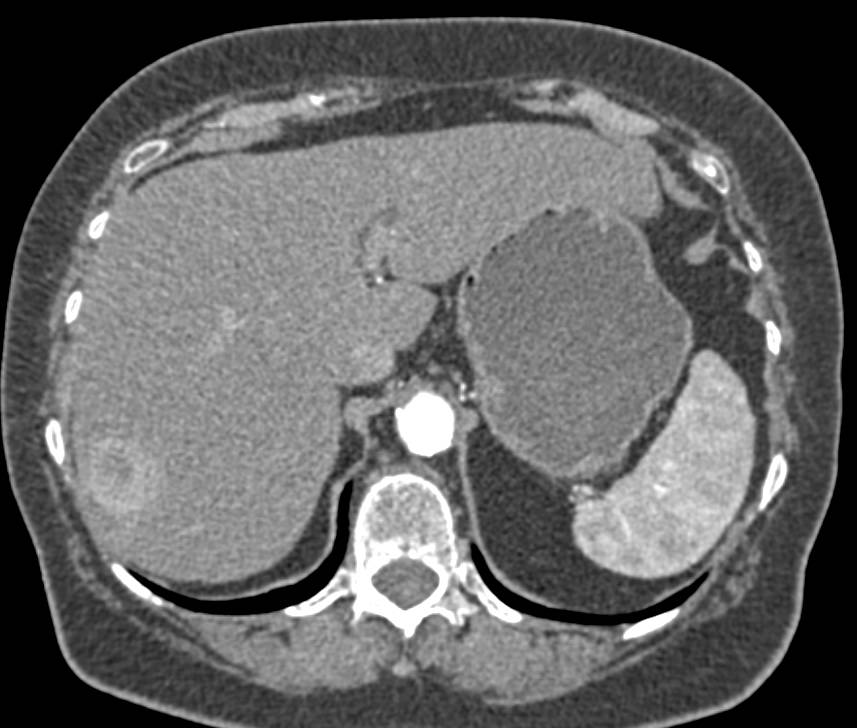 2 cm Hepatocellular Carcinoma (Hepatoma) - CTisus CT Scan