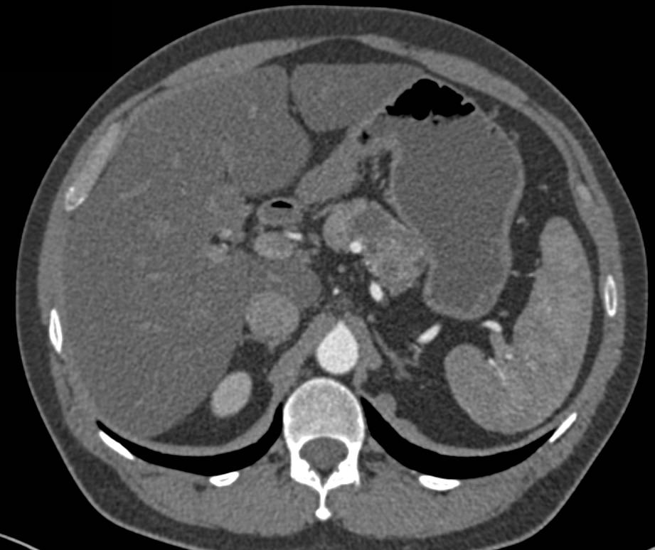 Serous Cystadenoma - CTisus CT Scan