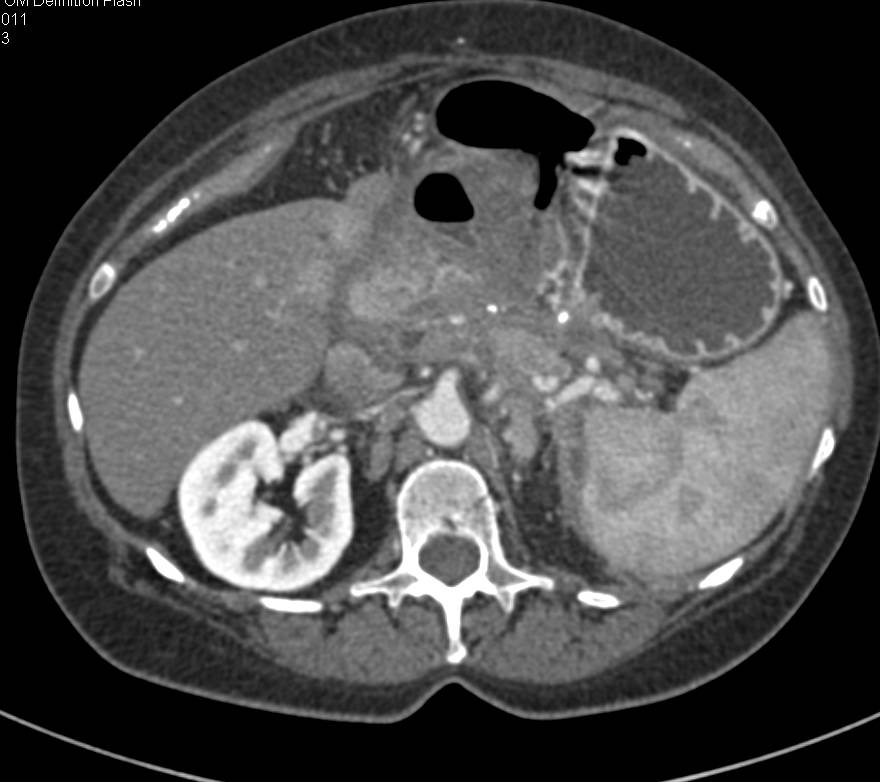 Recurrent Pancreatic Cancer with Left Nephrectomy - CTisus CT Scan