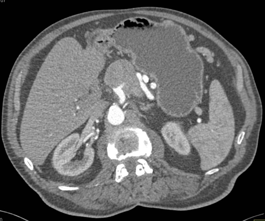 Neuroendocrine Tumor of the Pancreas with Venous Invasion - CTisus CT Scan