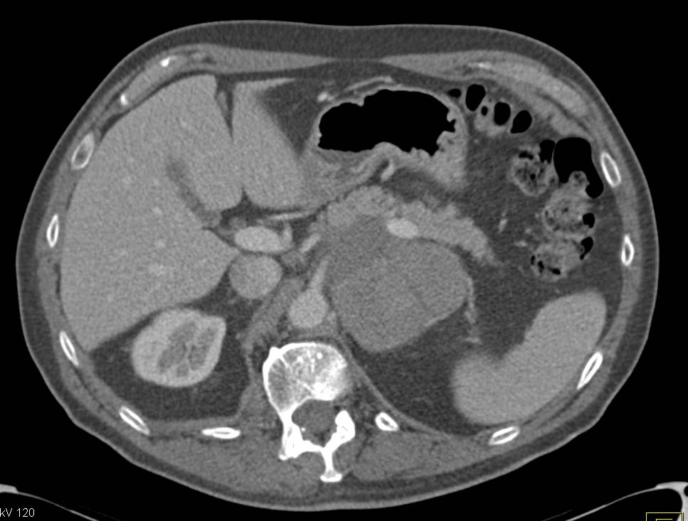 Possible MCN or Mucinous Cystic Neoplasm - CTisus CT Scan