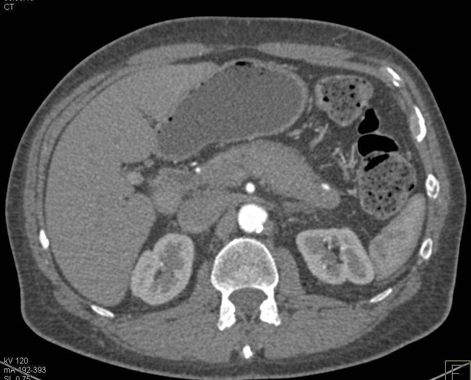 Autoimmune Pancreatitis - CTisus CT Scan