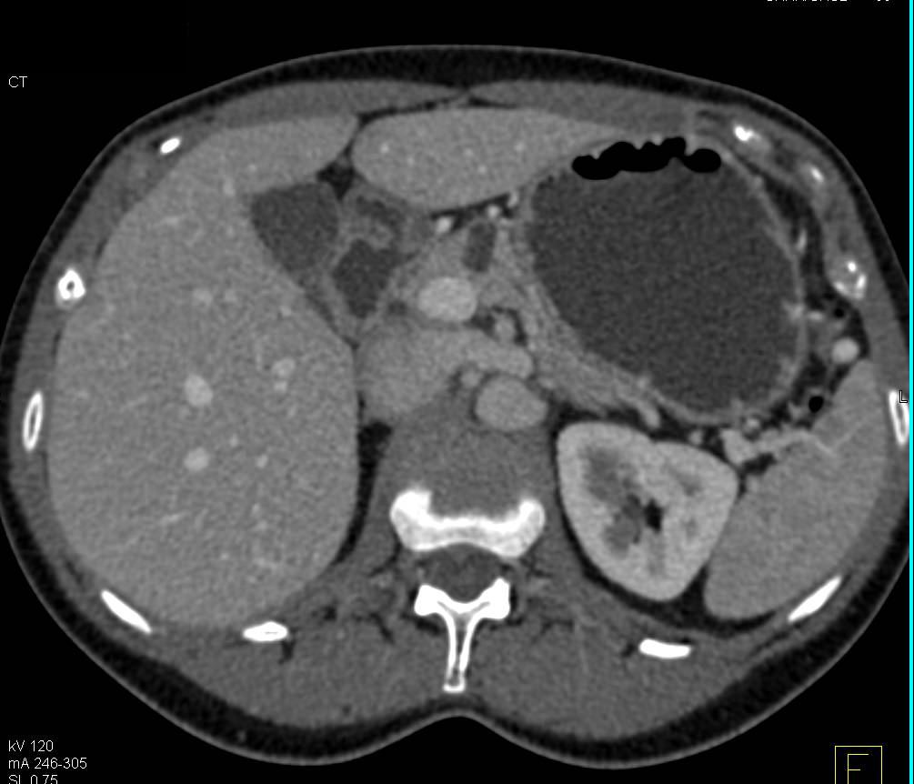 Pancreatic Intraductal Papillary Mucinous Neoplasm (IPMN) - CTisus CT Scan