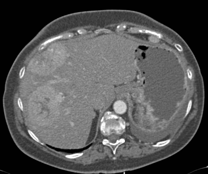 Metastatic Neuroendocrine Tumor Tail of Pancreas with Liver Metastases - CTisus CT Scan
