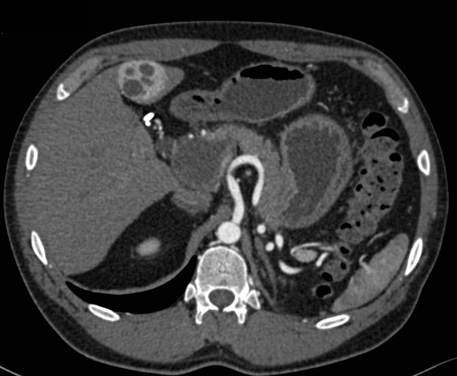 Mucinous Cystic Neoplasm of the Head of the Pancreas - CTisus CT Scan